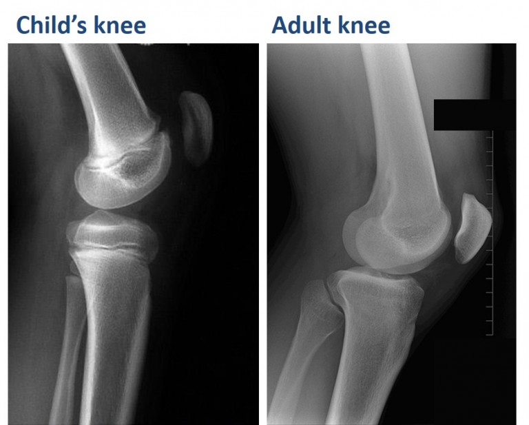 how-do-long-bones-grow-musculoskeletal-genetics