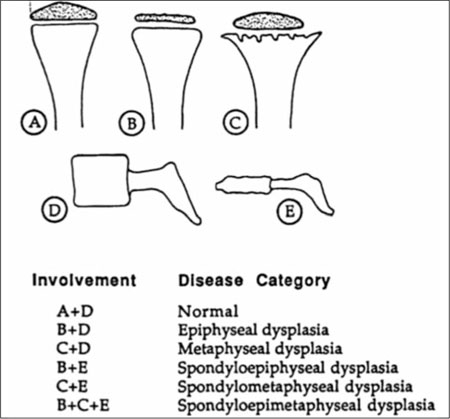 Skeletal dysplasias | Musculoskeletal Genetics